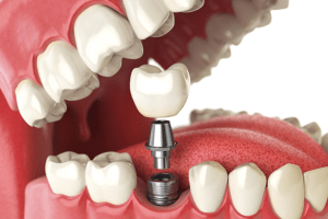 Ofertas en implantes dentales en Getafe o Leganés