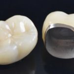 Corona de metal y porcelana: dentistas en Getafe o Leganés