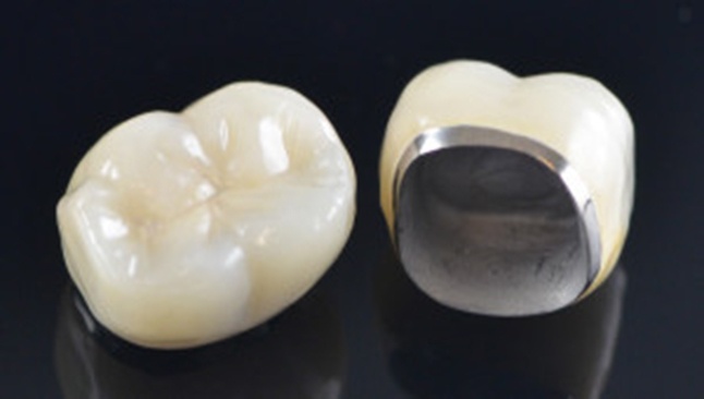 Dental Elizondo - Corona de porcela. Corona metal blanco