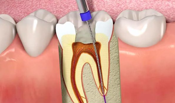 Endodoncia molar o anterior en Getafe o Pinto