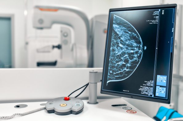 Mammogram snapshot of breasts of a female patient on the monitor