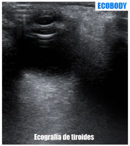 Ecografia de tiroides en Madrid